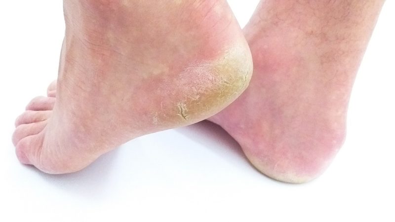 Podolog i przerwanie ciągłości tkanki na stopach