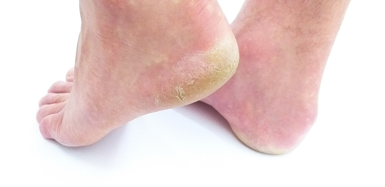 Podolog i przerwanie ciągłości tkanki na stopach